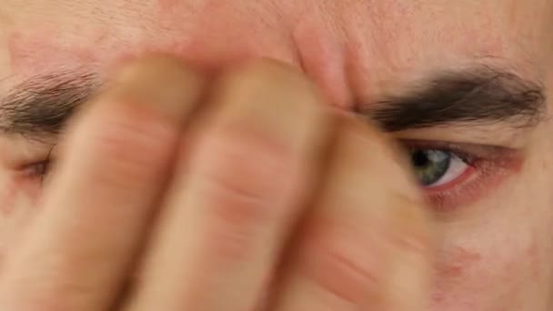 Humain Gratte Front Les Yeux Avec Réaction Allergique Rouge Rougeur — Video