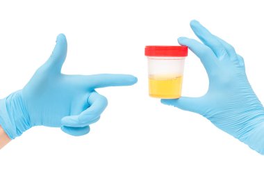urine sample analysis in a jar in hands gloves by a doctor or a bio lab worker. Urology and kidney diseases and urinary tract infections concept. clipart