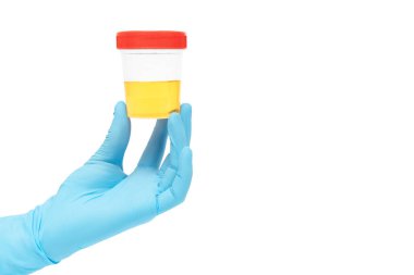 Kavanozdaki idrar örneği analizi bir doktor ya da biyoloji laboratuarı çalışanı tarafından eldiven içinde. Üroloji ve böbrek hastalıkları ve idrar yolu enfeksiyonları konsepti.