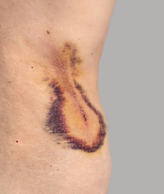 Büyük ağrılı hematom