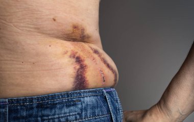 Büyük ağrılı hematom