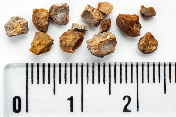 Kidney Stones Eswl Intervention Lithotripsy Scale Centimeters — Stock Photo, Image