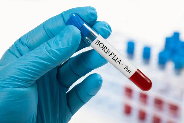 Borrelia Testi Için Elimde Kan Örneği Var — Stok fotoğraf