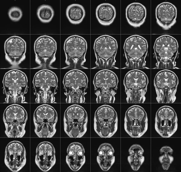 An MRI scan of a human head
