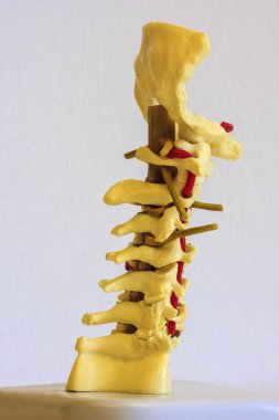 osteophyte oluşumu ile omurga disk dejenere 
