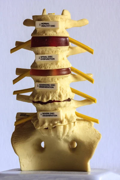 Bandscheibenvorfall Durch Osteophytenbildung Degeneriert — Stockfoto