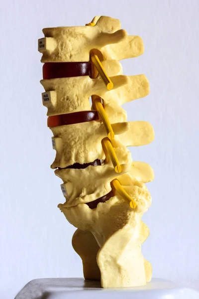 Spine Disc Degenerated Osteophyte Formation — Stock Photo, Image