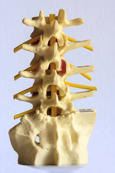 Spine Disc Degenerated Osteophyte Formation — Stock Photo, Image