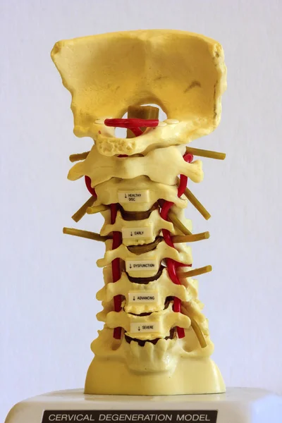 Spine Disc Degenerated Osteophyte Formation — Stock Photo, Image