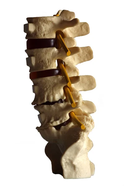 Δίσκος Της Σπονδυλικής Στήλης Εκφυλισμένο Από Σχηματισμό Osteophyte — Φωτογραφία Αρχείου