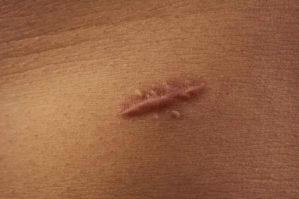 Scar on human skin — Stock Photo, Image