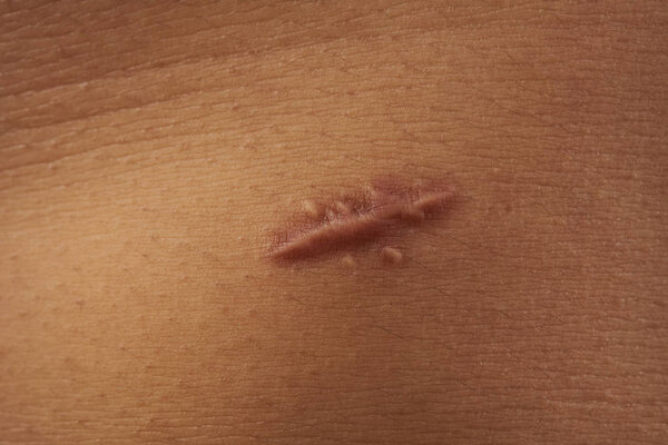 Scar on human skin