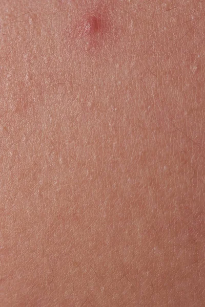 Textura da pele humana com espinha vermelha — Fotografia de Stock