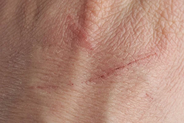 Skin with fresh scratches from cat — Stock Photo, Image