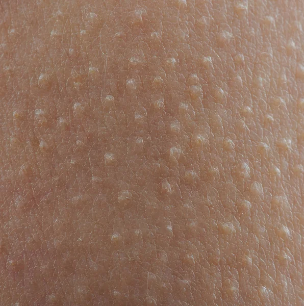 Solavancos de ganso na pele marrom — Fotografia de Stock