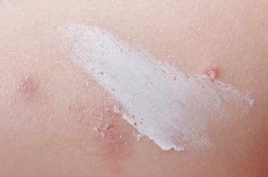 Cilt skar üzerine krem uygulama