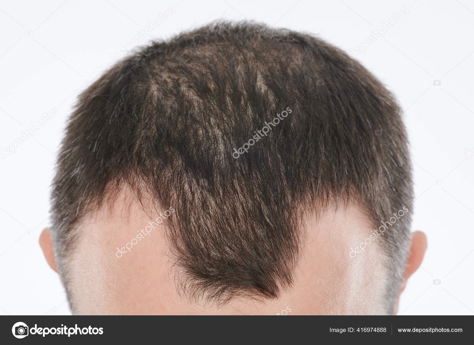 Man Losing Hair Head Close Isolated White Background Stock Photo by  ©dimarik 416974888