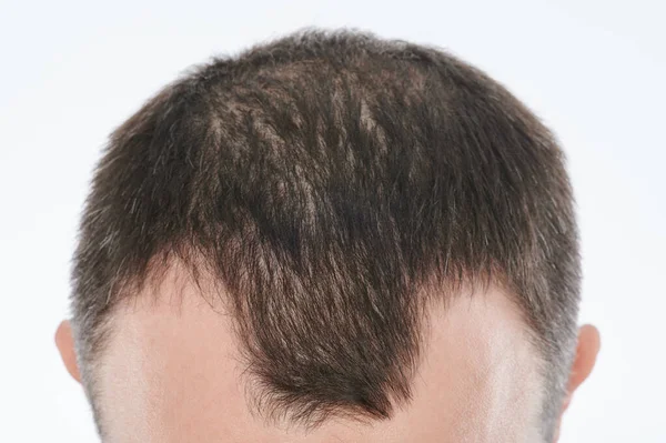Человек Теряет Волосы Голове Близко Изолированному Белом Фоне — стоковое фото