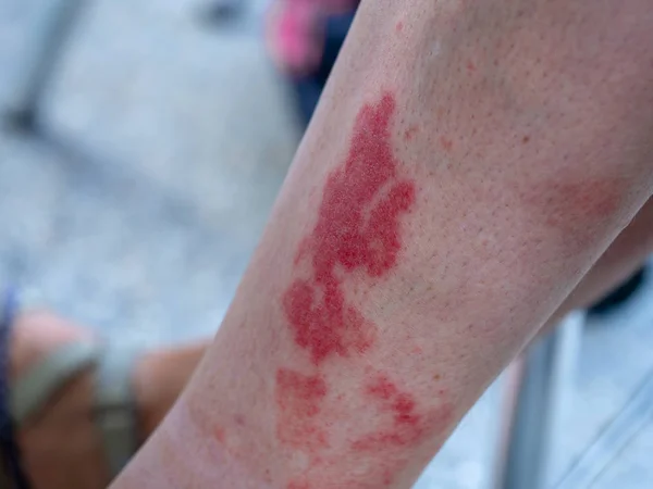 Vasculitis leucocitoclástica, una reacción inflamatoria en los vasos sanguíneos. Golfistas de Aka, excursionistas o vasculitis inducida por el ejercicio o erupción Disney . —  Fotos de Stock