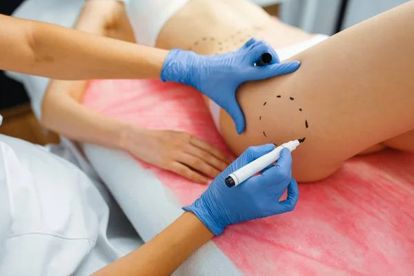 Cosmetician Com Marcador Coloca Linhas Pontilhadas Corpo Paciente Feminino Preparação — Fotografia de Stock