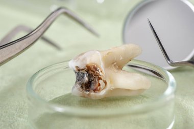 ayıklanan molar diş çürüğü ve amalgam