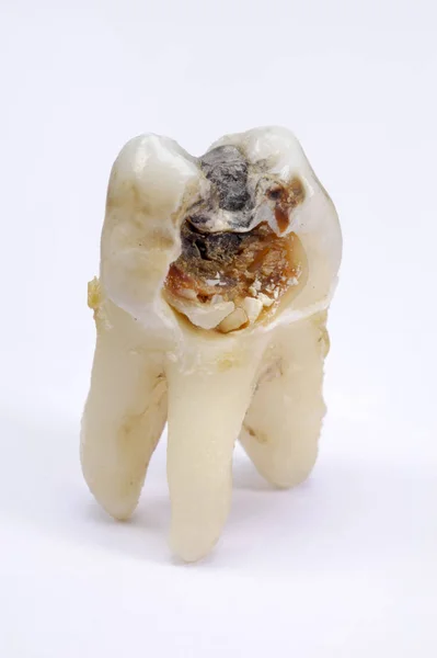 Dent Molaire Extraite Avec Caries Amalgame — Photo