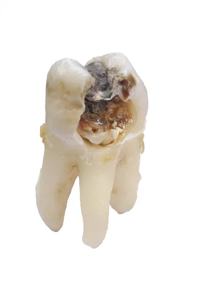 Diente Molar Extraído Con Caries Amalgama — Foto de Stock