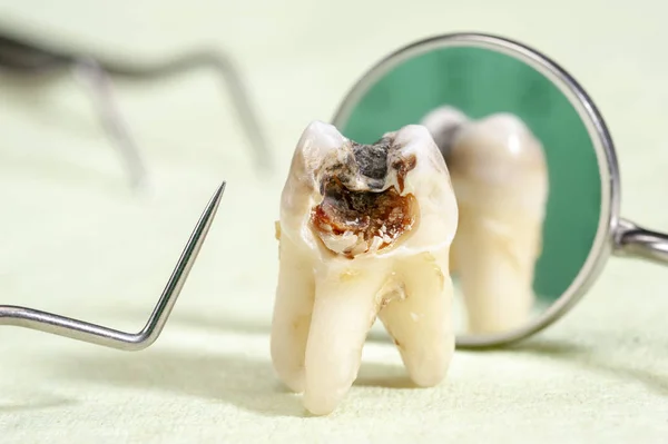 Dent Molaire Extraite Avec Caries Amalgame — Photo