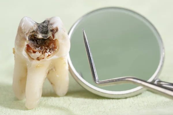 Dente Molar Extraído Com Cárie Amálgama — Fotografia de Stock