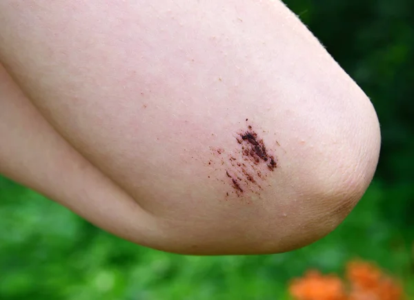 Legs Teenager Fresh Abrasion His Elbow — Stock Photo, Image