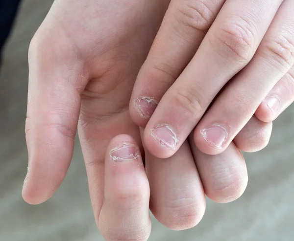 De handen van de tiener met bramen op de vingernagel. Nibbles vingernagel — Stockfoto