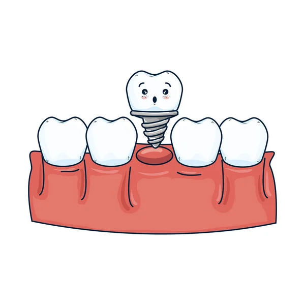 人的牙齿与牙种植体川井 — 图库矢量图片