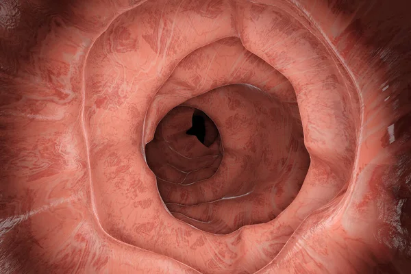 3D Illustratie van een gastro-intestinale poliep tijdens Entersocopy — Stockfoto