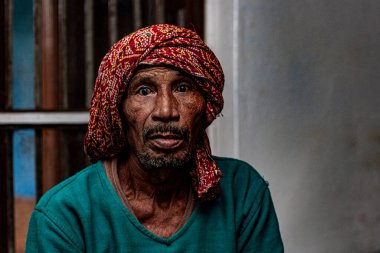 Sundarpur, Hindistan - 2013: Hindistan 'ın Bihar eyaletindeki yerel bir cüzzamlı hastanesinde kimliği belirsiz Hintli cüzzamlı hastalar