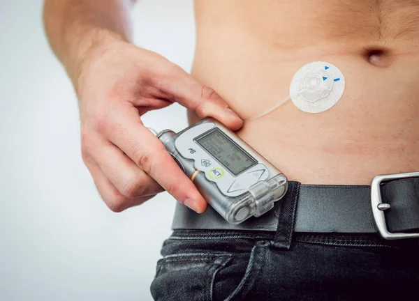 Diabetiker Man Med Insulinpump Ansluten Hans Buk Och Hålla Insulinpumpen — Stockfoto