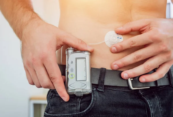 Diabetic man with an insulin pump connected in his abdomen and keeping the insulin pump on his belt. Diabetes concept.