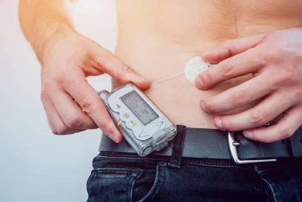 Diabetic man with an insulin pump connected in his abdomen and keeping the insulin pump on his belt. Diabetes concept.