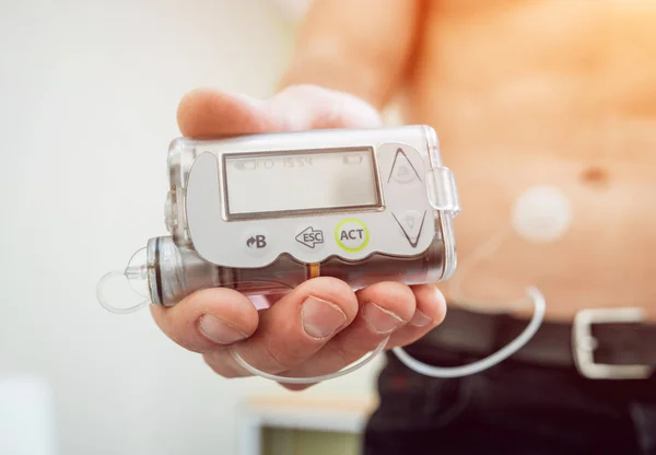 Diabetic man with an insulin pump connected in his abdomen and holding the insulin pump at his hands. Diabetes concept.