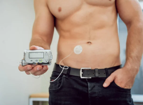 Diabetic man with an insulin pump connected in his abdomen and holding the insulin pump at his hands. Diabetes concept.