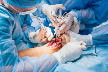 Travma cerrahisi operasyon süreci. Ameliyathane cerrahi ekipman ile cerrahlarından grubudur. Tıbbi geçmişi