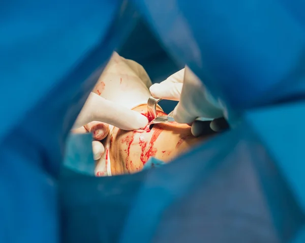 Διαδικασία Της Τραύμα Χειρουργικής Επέμβασης Ομάδα Χειρουργών Στο Λειτουργικό Δωμάτιο — Φωτογραφία Αρχείου