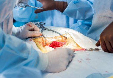 Omurilik ameliyatı. Ameliyathanede ameliyathanede ameliyat aleti olan bir grup cerrah. Laminektomi. Modern tıbbi arka plan