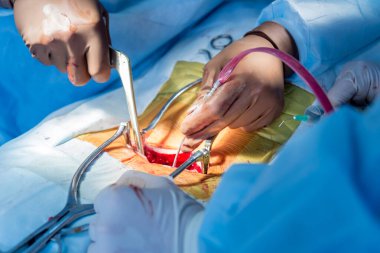 Omurilik ameliyatı. Ameliyathanede ameliyathanede ameliyat aleti olan bir grup cerrah. Laminektomi. Modern tıbbi arka plan