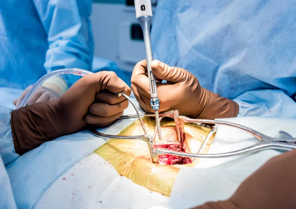 Omurga ameliyatı. Cerrah hastanın omuriliğine poliyaxial vidayı sıkılaştırır. Ameliyat ekipmanlarıyla ameliyathane. Laminektomi. Omurga saplantı sistemleri. Tıbbi geçmiş