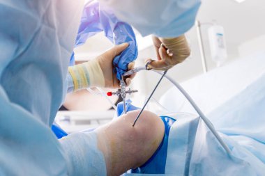 Artroskop ameliyatı. Modern artroskopik aletlerle ameliyathanede takım çalışması yapan ortopedik cerrahlar. Diz ameliyatı. Hastane geçmişi