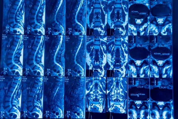 腰椎扫描 慢性背痛患者 — 图库照片