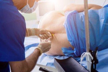 Epidural anestezi iğneleri. Ameliyat için hazırlanın. Tıbbi geçmiş