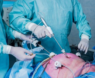 Laparoskopik ekipman kullanılarak yapılan jinekolojik ameliyat. Ameliyathanede ameliyat ekipmanlarıyla bir grup cerrah. Tıbbi geçmiş