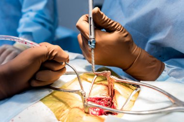 Omurga ameliyatı. Cerrah hastanın omuriliğine poliyaxial vidayı sıkılaştırır. Ameliyat ekipmanlarıyla ameliyathane. Laminektomi. Omurga saplantı sistemleri. Tıbbi geçmiş