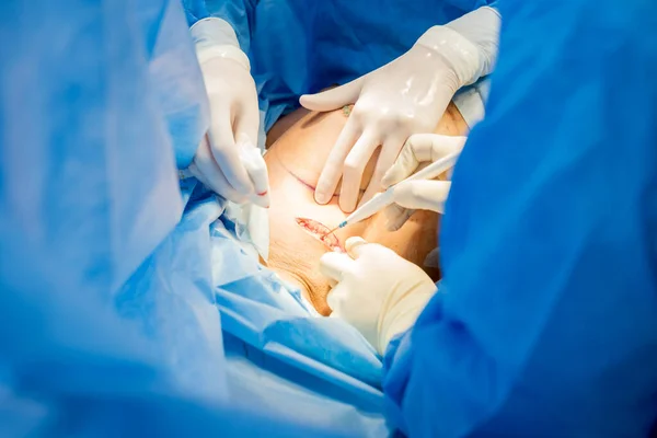 Operation zur Entfernung der Brust und deren Ersatz durch ein Implantat. — Stockfoto